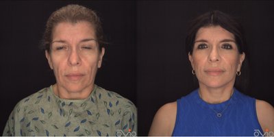 Neck Lift before and after photo