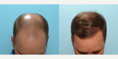 FUE Hair Transplant before and after photo