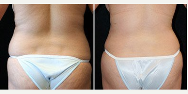 Liposuction before and after photo