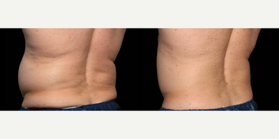 BodyTite before and after photo