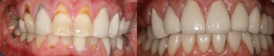 Dental Crown before and after photo