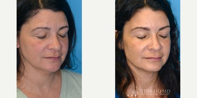 Eyelid Surgery before and after photo