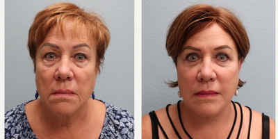 Facelift before and after photo