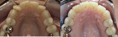 Invisalign before and after photo