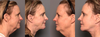 Neck Lift before and after photo