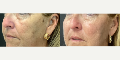 Radiesse before and after photo