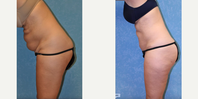 Tummy Tuck before and after photo