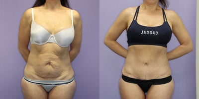 Panniculectomy before and after photo