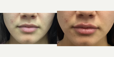 Volbella before and after photo