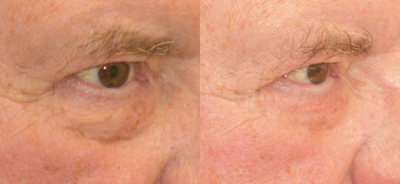 Eyelid Surgery before and after photo
