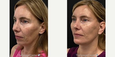 Facelift before and after photo