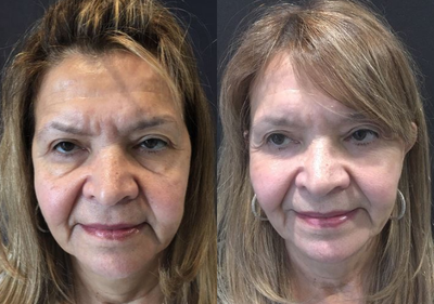 Eyelid Surgery before and after photo