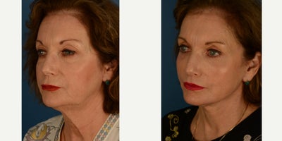 Facelift before and after photo