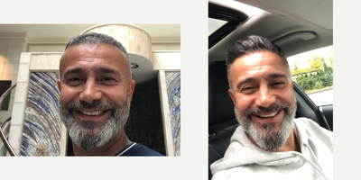 FUE Hair Transplant before and after photo