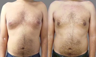 Gynecomastia Surgery before and after photo
