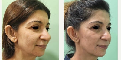 before and after image