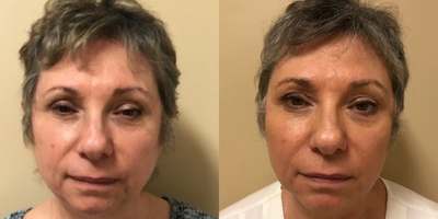 Vampire Facelift before and after photo