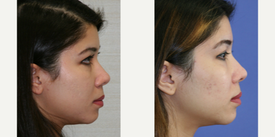 Asian Rhinoplasty before and after photo