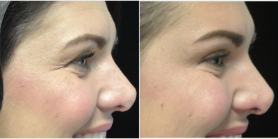 Botox before and after photo
