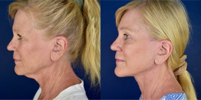 before and after image