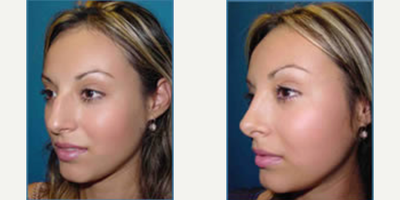 Rhinoplasty before and after photo