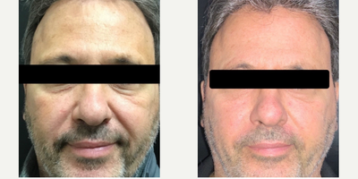 Belotero before and after photo