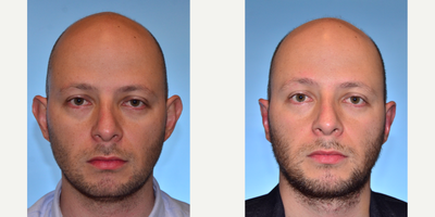 Ear Surgery before and after photo