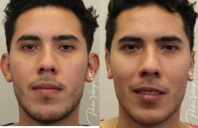 Ear Surgery before and after photo