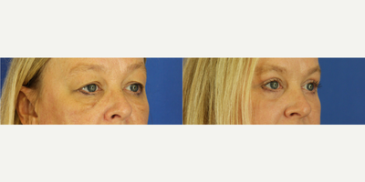 Eyelid Surgery before and after photo