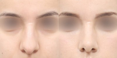 Rhinoplasty before and after photo