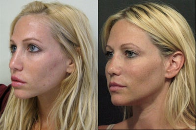 Sculptra before and after photo