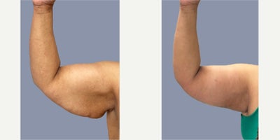 Skin Tightening before and after photo