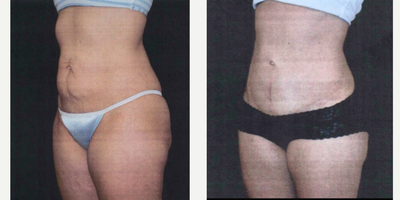 Tummy Tuck before and after photo