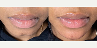 Chin Filler before and after photo
