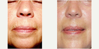 CO2 Laser before and after photo