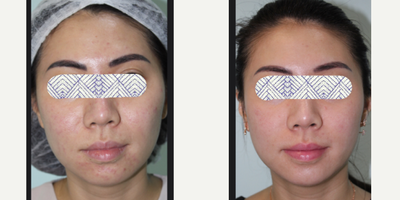 EndyMed 3Deep before and after photo