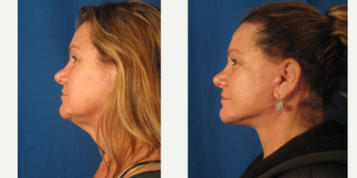 Facelift before and after photo