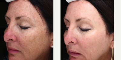 Halo Laser before and after photo