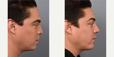 Revision Rhinoplasty before and after photo