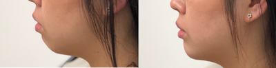 Bellafill before and after photo