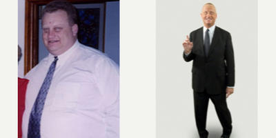 Gastric Bypass before and after photo