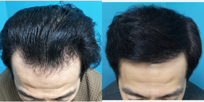 Hair Transplant before and after photo