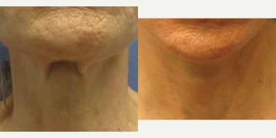 Lower Facelift before and after photo