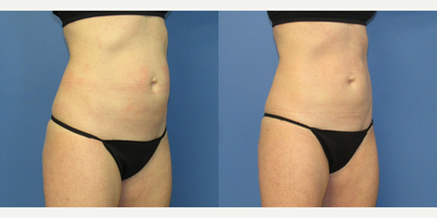 CoolTone before and after photo