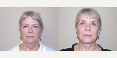 Facelift before and after photo
