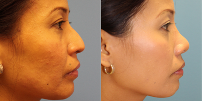 Rhinoplasty before and after photo