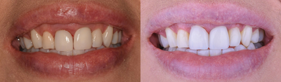 Smile Makeover before and after photo