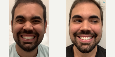 Botox for Gummy Smile before and after photo