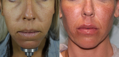 Dermal Fillers before and after photo