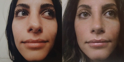 Revision Rhinoplasty before and after photo